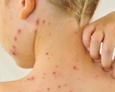 Случаите на морбили вече са 51! Ядрото на заболели все още е в Благоевград