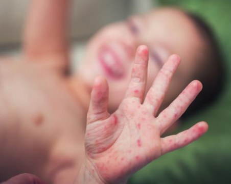 Бебе на 12 месеца се е заразило с морбили в Пловдивско, антиваксърите се множат