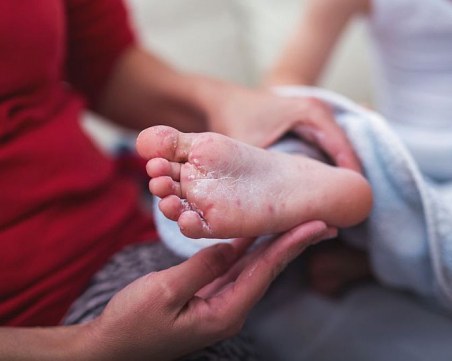 Първи случай на морбили в Пловдив