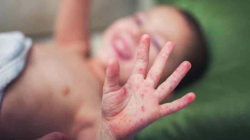 Бебе на 12 месеца се е заразило с морбили в Пловдивско, антиваксърите се множат