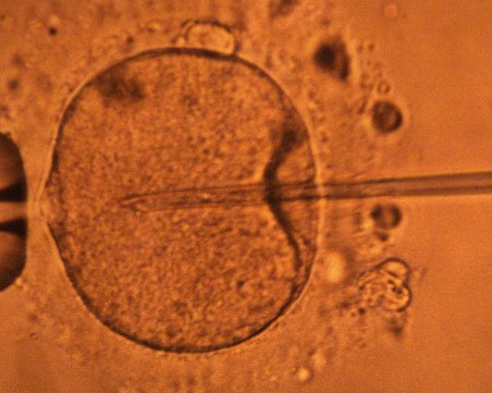 Всяка 10 българка застрашена от безплодие. Бичът се нарича ендометриоза