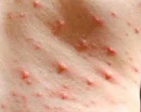 500 са вече болните от морбили! Заболяването се разраства в София