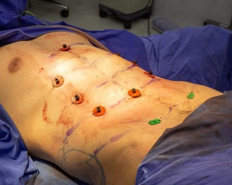 Вече може да си имплантирате плочки