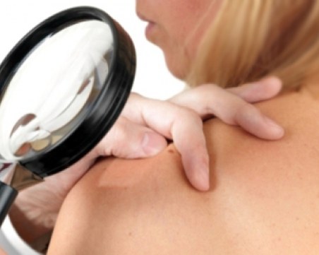 Дерматолози във ВМА преглеждат за рак на кожата безплатно