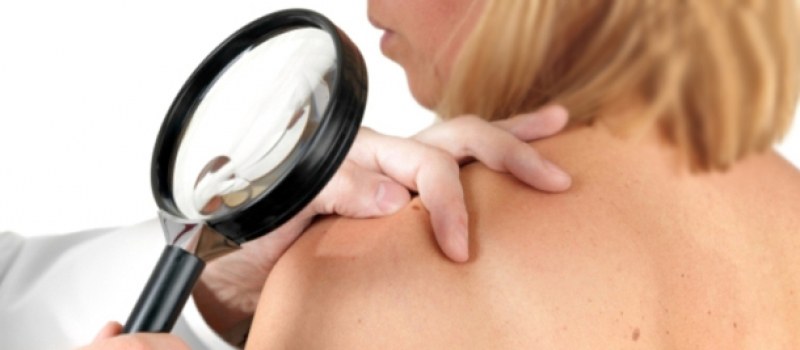 Дерматолози във ВМА преглеждат за рак на кожата безплатно