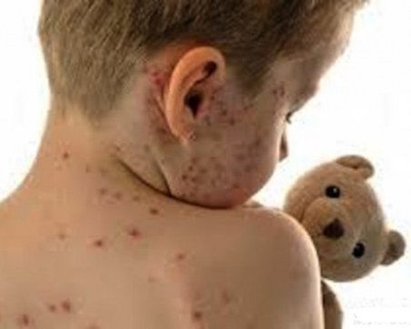 Варицелата се развилня във Варна! 222-ма заразени за седмица!