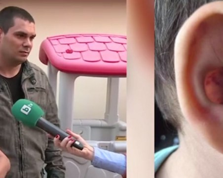2-годишно се върна от ясла с хематом. Учителите: Буйно е, да ходи на психолог!