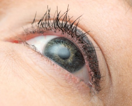 Извадиха няколко червея от окото на 14-годишно момиче от Пловдив