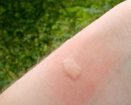 Пловдивски лекар съветва как да се предпазим от комари и кърлежи