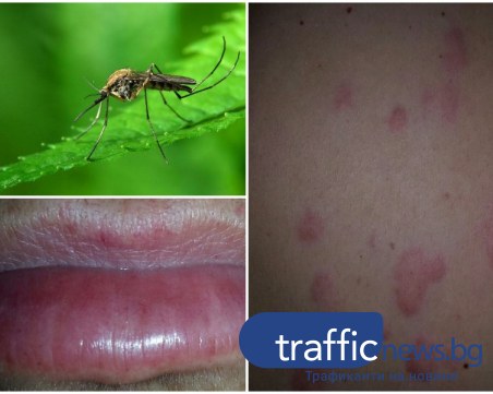 Ухапване от насекомо повали пловдивчанка за седмица! Лекари предупреждават за остри реакции