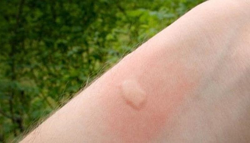 Пловдивски лекар съветва как да се предпазим от комари и кърлежи