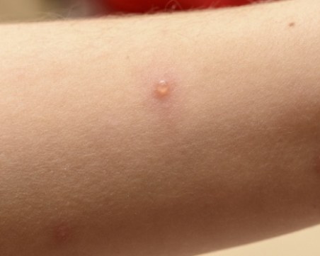 933 са заразените с морбили. Епидемия в България – няма!