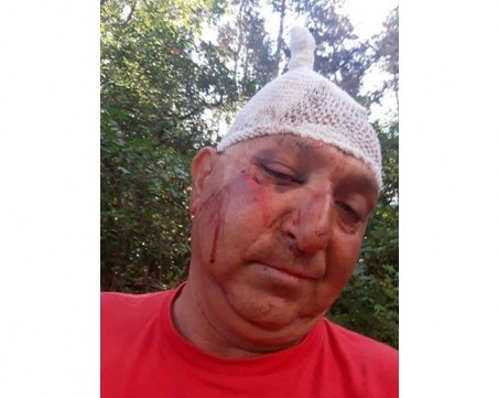 Счупени чене и ръка, 9 шева на главата: Семейство пребито от съседи в дома им