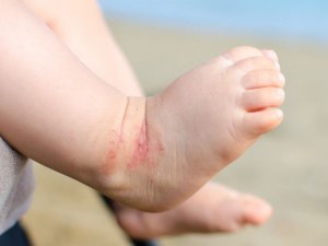Откриват безплатно училище за деца с атопичен дерматит в Пловдив