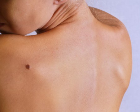 Кои бенки са опасни и кога трябва да отидем на лекар?