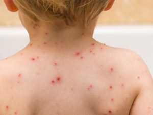 Бум на варицела в София и Варна