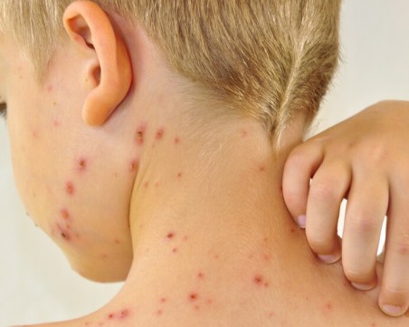 Бум на варицела обхвана Пазарджик