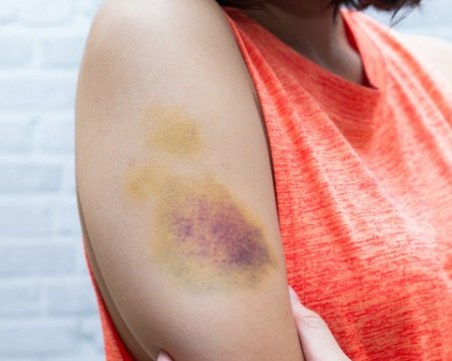 Причини за лесна поява на синини по тялото