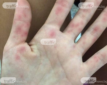 Пловдивчани масово се връщат от морето с температура и обриви