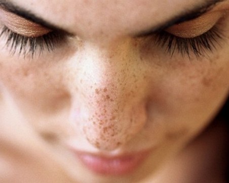 10 натурални продукта, които премахват пигментните петна
