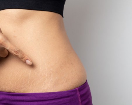 Как да премахнете стриите след отслабване?