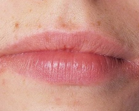 Венеролозите предупреждават: Бум на сифилис и още 