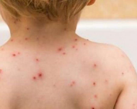 Експерт: Може да избухне епидемия от морбили в София