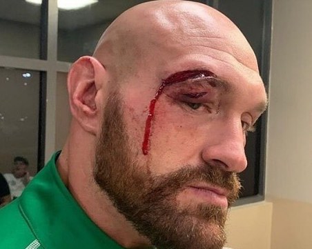 Уайлдър разкри какво ще направи с раната на Фюри