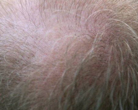 Работохолиците с по-висок риск от оплешивяване