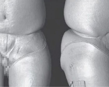 Присадиха пенис и скротум на американски войник, настъпил мина в Афганистан