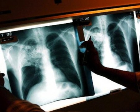 Цяла седмица ще ни преглеждат безплатно за туберкулоза