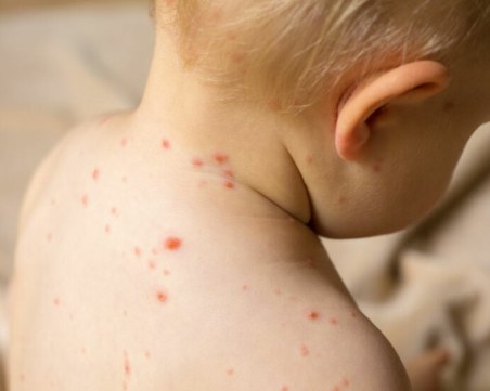 Нови 12 случая на болни от морбили регистрирани в Пазарджишко