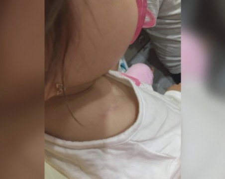 Посиненото 2-годишно дете изпаднало в истерия след посещение в ясла