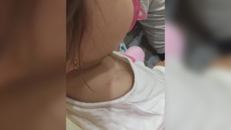 Посиненото 2-годишно дете изпаднало в истерия след посещение в ясла