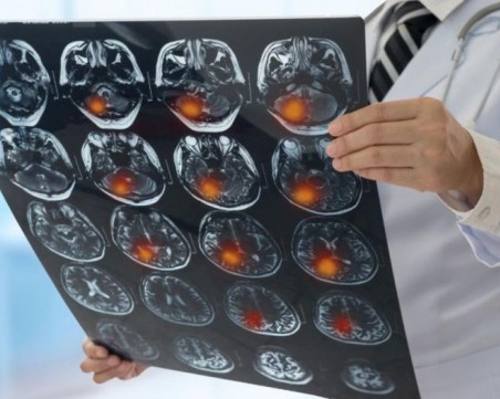 150 души на ден получават инсулт