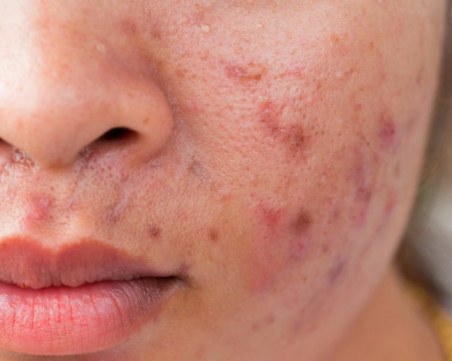 Разследват лекарство срещу акне след 10 самоубийства