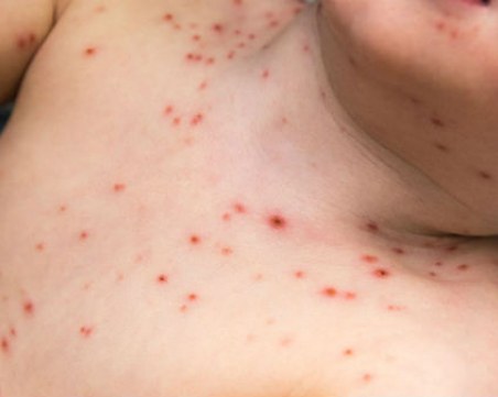 Над 2000 болни от варицела у нас, карантини в детските градини