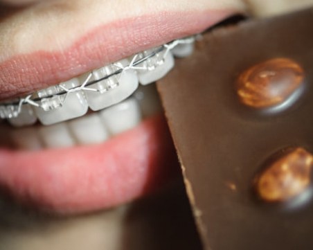 Топ 5 на храни и напитки, които съсипват зъбите ви