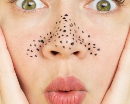 Съвети за премахване на черните точки от носа