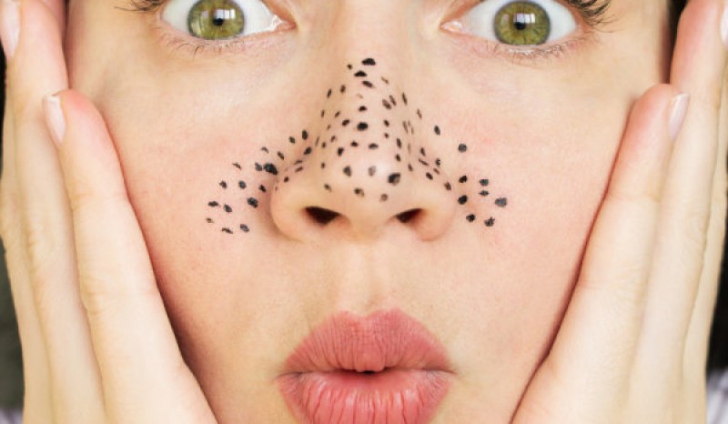 Съвети за премахване на черните точки от носа