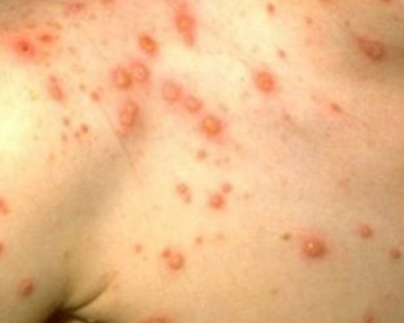 5-годишно момченце издъхна в болница, съмняват се за морбили