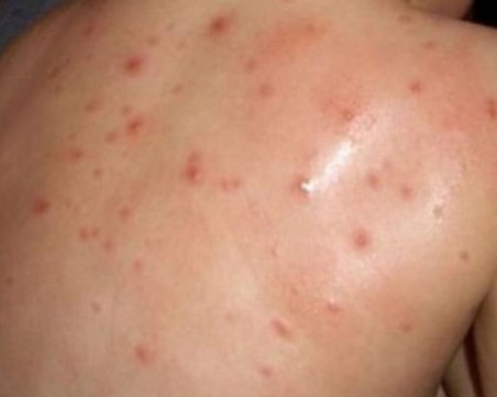 3-годишно дете без ваксина се разболя от морбили в Хасково