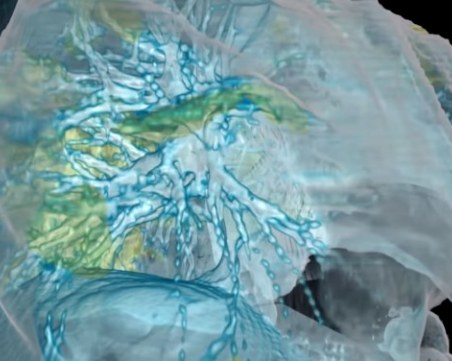 Американски лекари показват как COVID-19 поразява белия дроб