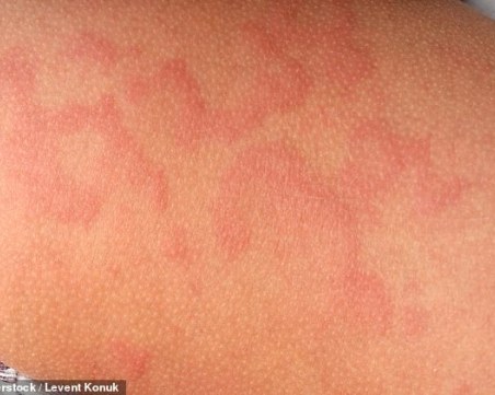 Как кожата алармира за COVID-19?