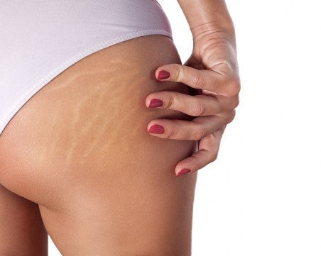 Ето как да намалим видимостта на стриите