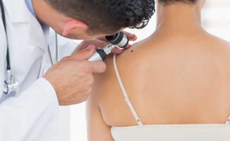 Дерматолог: Все повече са случаите на рак на кожата