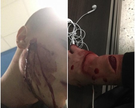 Следствено дело търси виновника, нарязал лицето на фен на Локото при сбиване