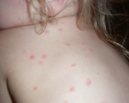 Двойно повече болни от варицела за седмица