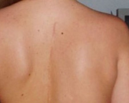 Заради COVID-19 случаите с гръбначни изкривявания в Пловдив се увеличават