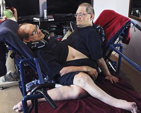 Починаха най-възрастните сиамски близнаци